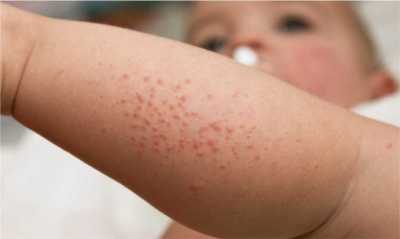 аллергия на ткань