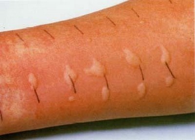 кожные аллергические пробы при аллергии на члене