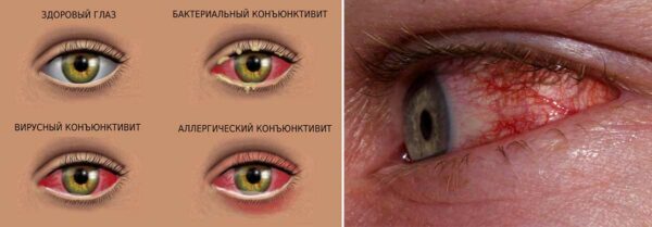 Чем промыть глаза при аллергии