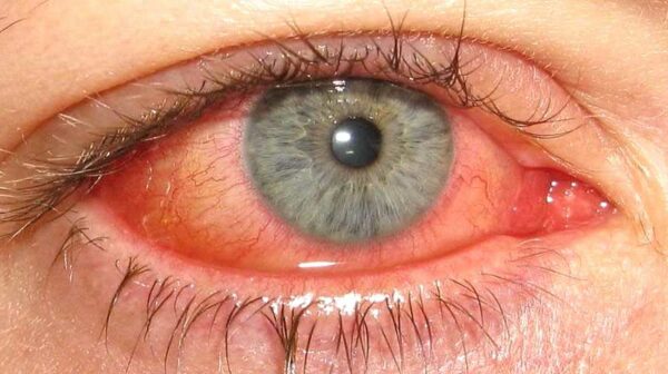 Зудятся глаза от аллергии что делать