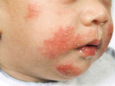 Аллергия на лице у ребенка