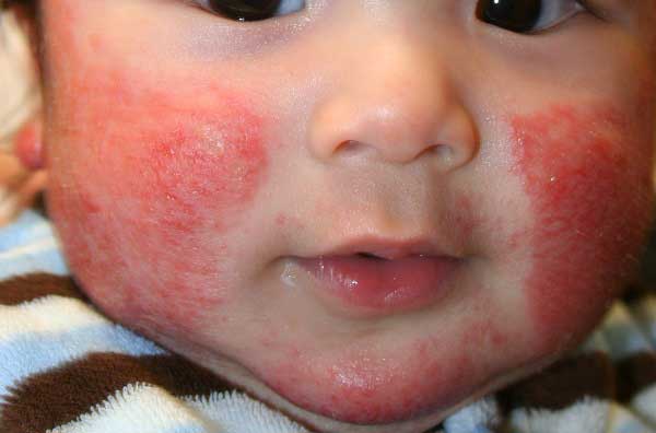 аллергия на сладкое у детей симптомы