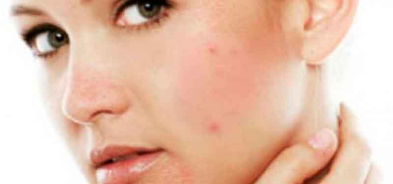 Причины и способы лечения аллергии на лице