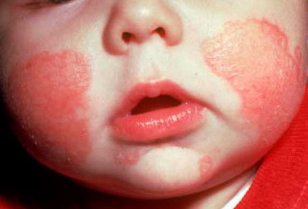 Детский дерматит