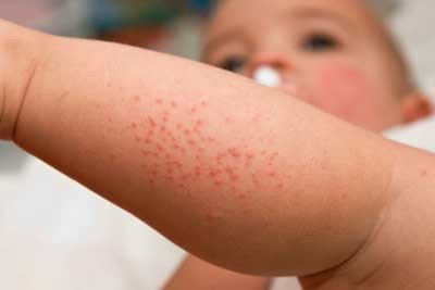 Аллергии на коже