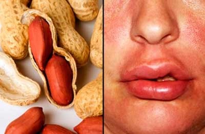 аллергия на арахис симптомы