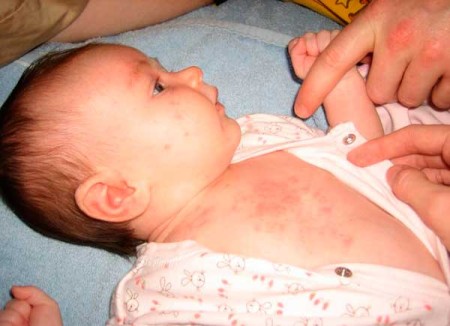 аллергия или потница у новорожденного