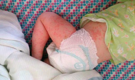 аллергия на пенициллин у ребенка