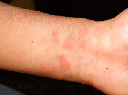 как выглядит аллергия на руках