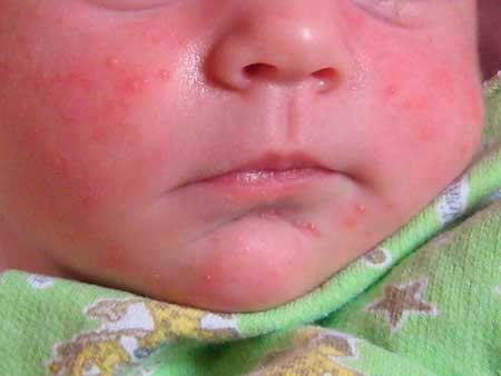 как выглядит аллергия у новорождённого
