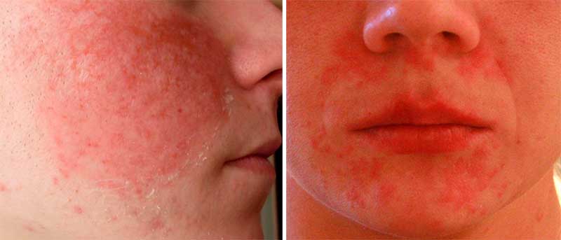 Признаки аллергии на лице