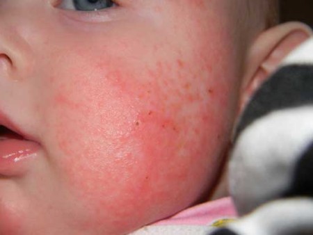 аллергия на аквадетрим