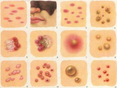Какие существуют гормональные мази от аллергии