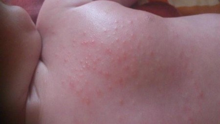аллергия на Аквадетрим