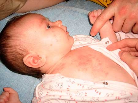 аллергия на сливочное масло у ребенка