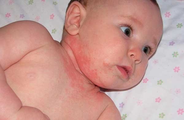 аллергия на шее у ребенка