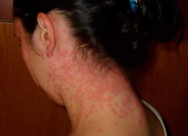аллергия на укусы насекомых на шее