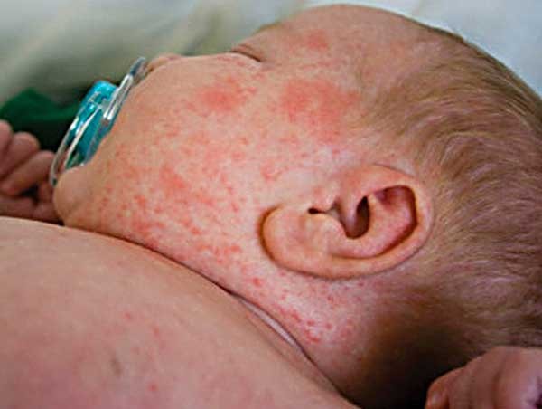 аллергия на арбуз у ребенка симптомы