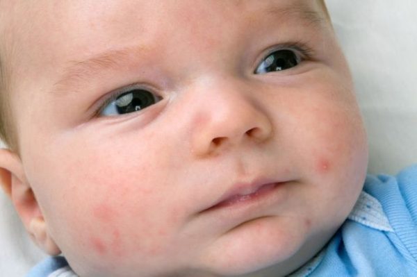 Аллергия у грудничка на лице