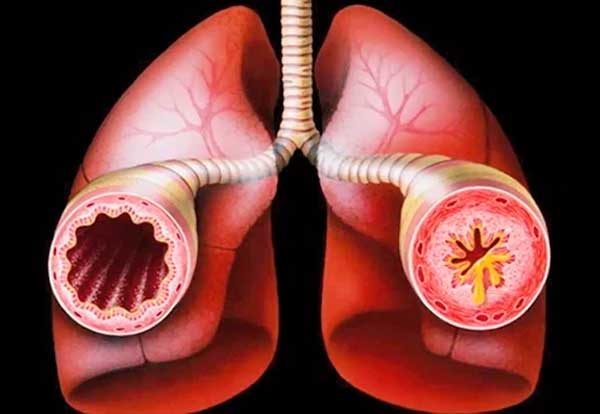 Аллергическая астма у детей и взрослых, симптомы, лечение