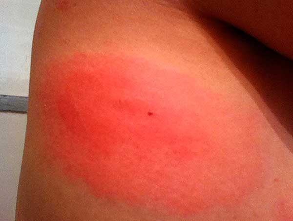 аллергия на комаров симптомы