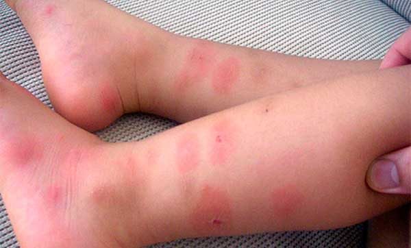 аллергия от укуса комара у ребенка
