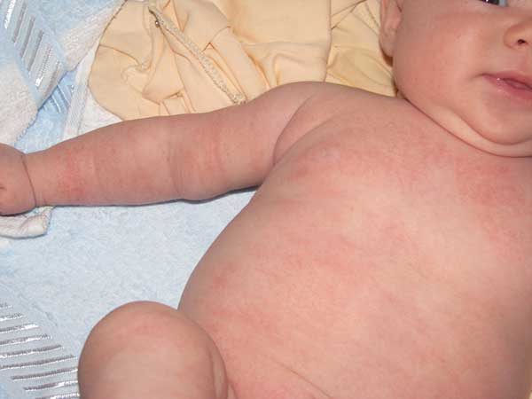аллергия на виферон у ребенка
