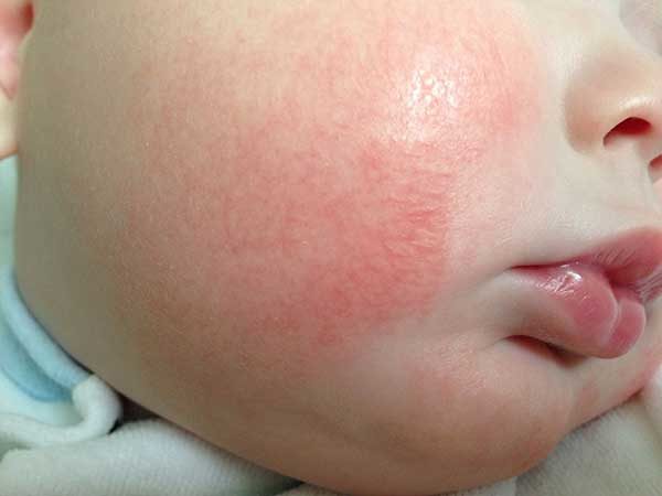у ребенка аллергия виферона