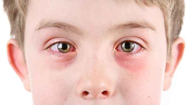 корица аллергия у детей
