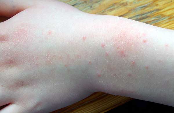 аллергия на синтетику симптомы