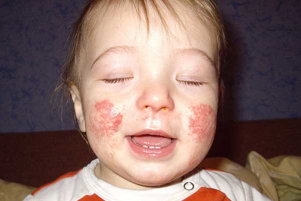 дерматит у детей на лице