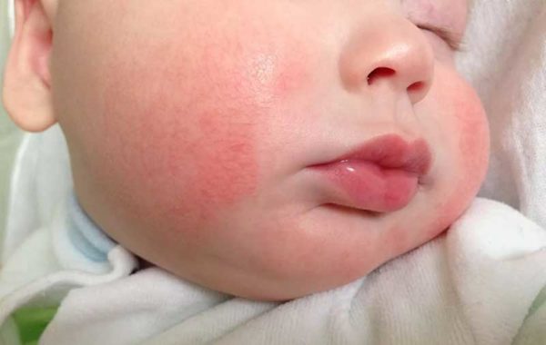 аллергия на картофель у младенца