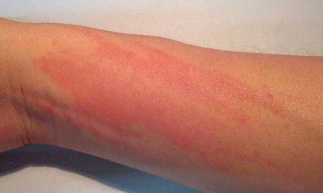 Аллергия на ольху и березу чем лечить
