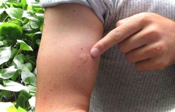 аллергия на коже от укуса комара