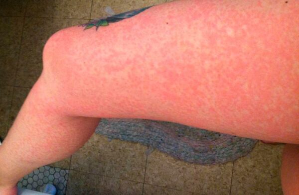 аллергия на холод симптомы