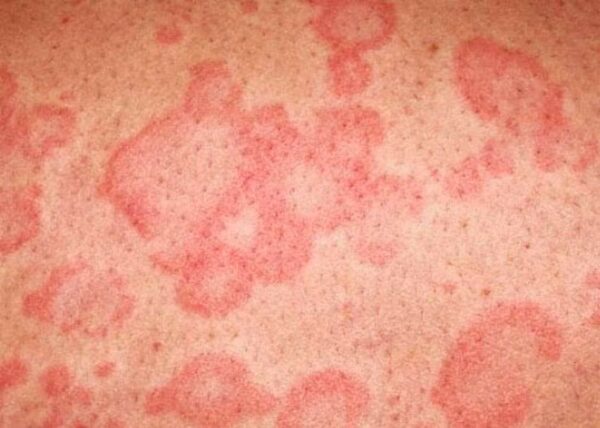 симптомы холодовой аллергии