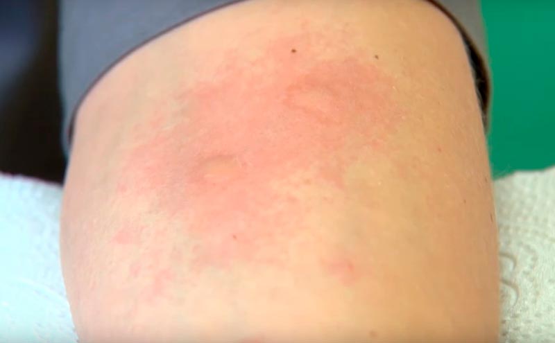 Как узнать на что аллергия? Видео