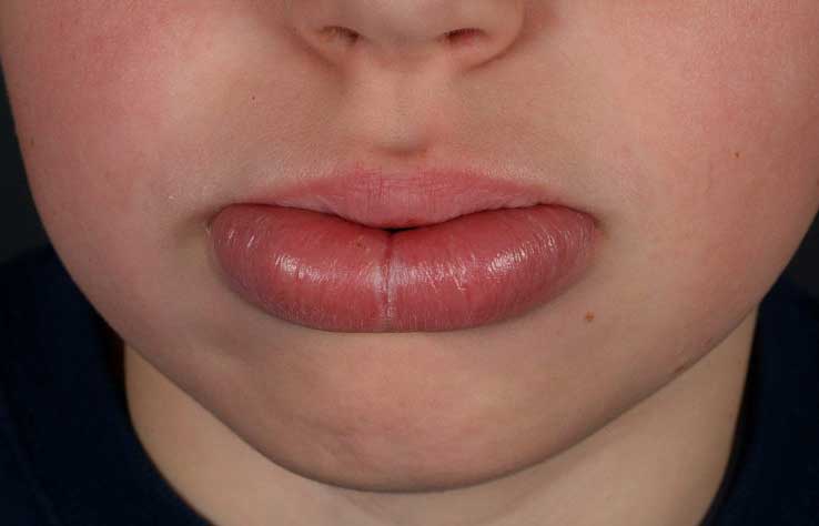 Аллергия на зубную пасту: может ли быть и чем опасна?