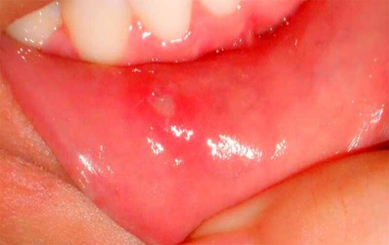 Аллергия на зубную пасту: может ли быть и чем опасна?